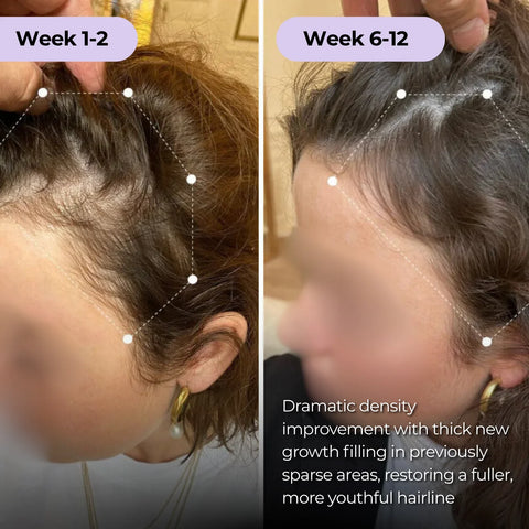 Ever Glo Hair Regrowth Micro-Infusion System for Woman