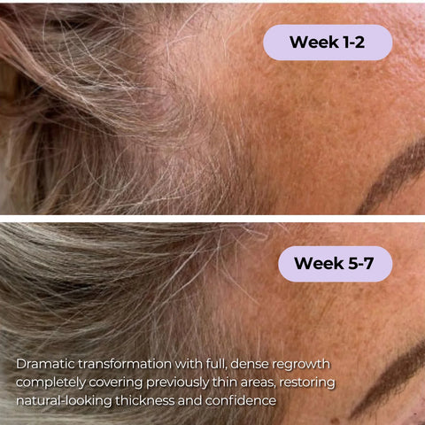 Ever Glo Hair Regrowth Micro-Infusion System for Woman