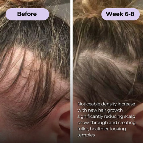 Ever Glo Hair Regrowth Micro-Infusion System for Woman