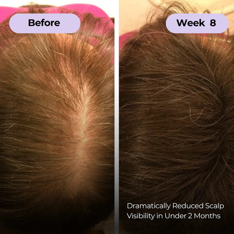 Ever Glo Hair Regrowth Micro-Infusion System for Woman