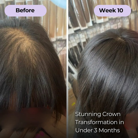 Ever Glo Hair Regrowth Micro-Infusion System for Woman